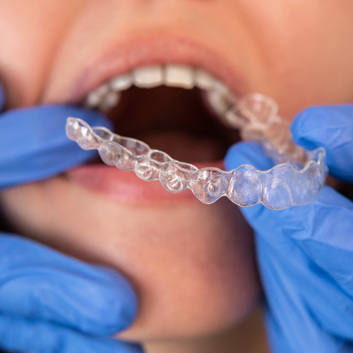 placa-oclusal